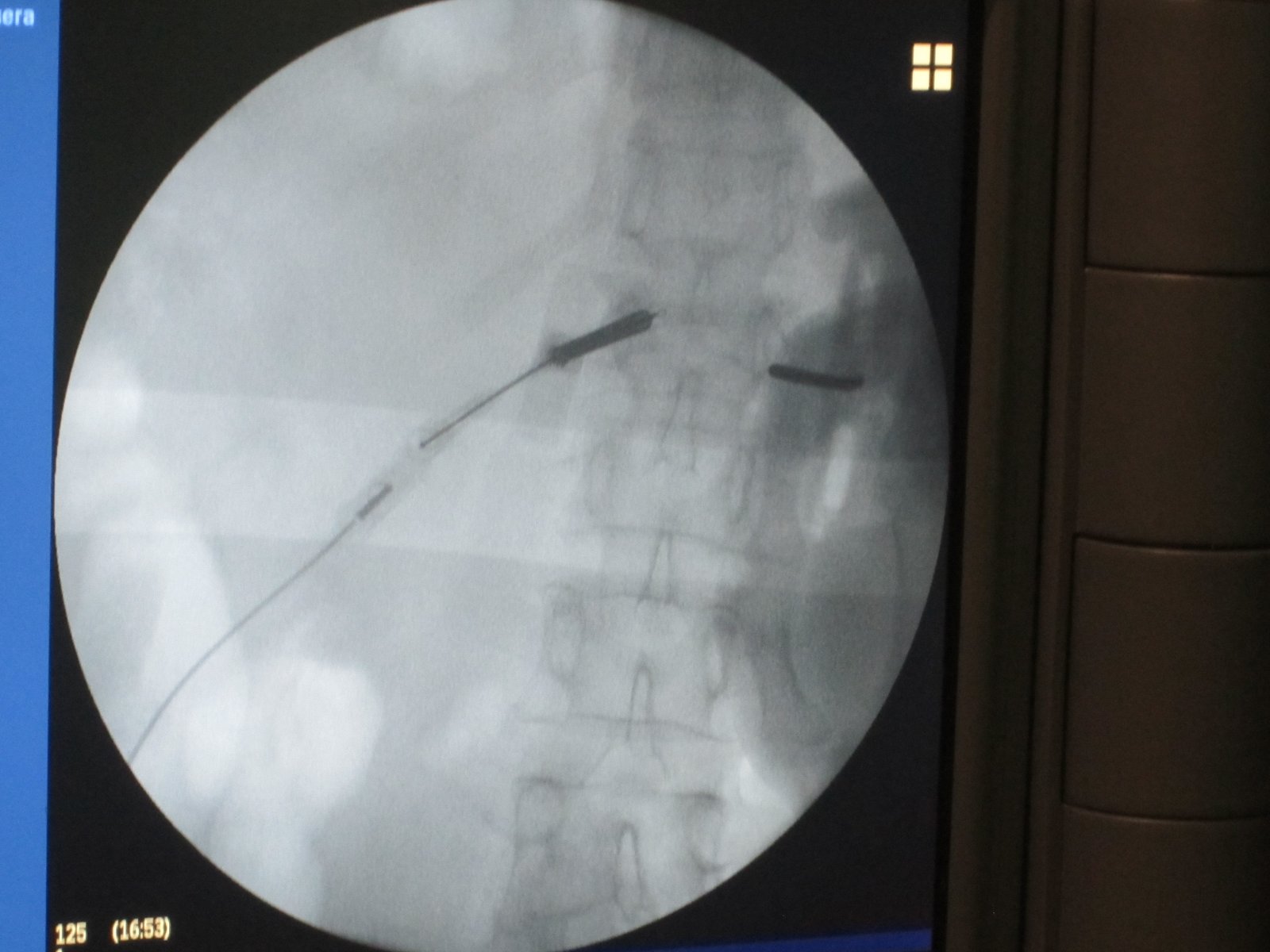 Fibrosis Epidural